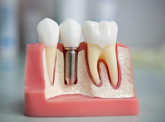 Види та класифікація знімних зубних протезів