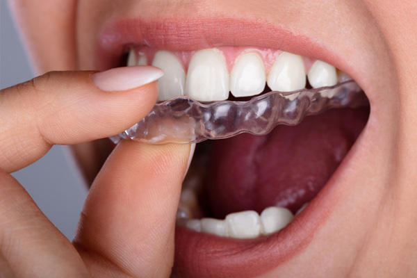 Чому варто обрати ортодонтичні капи в стоматології Діамант?